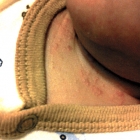 Eczema on neck